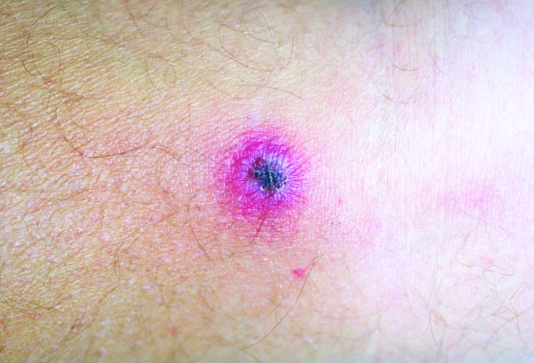 Rickettsien: Gefährliche Bakterien, die jeder kennen&nbsp;sollte